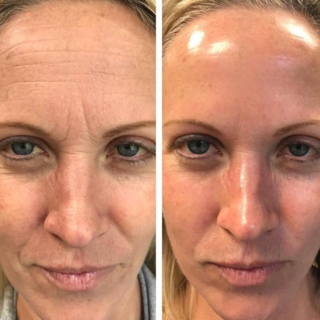 Olera Botox Serum